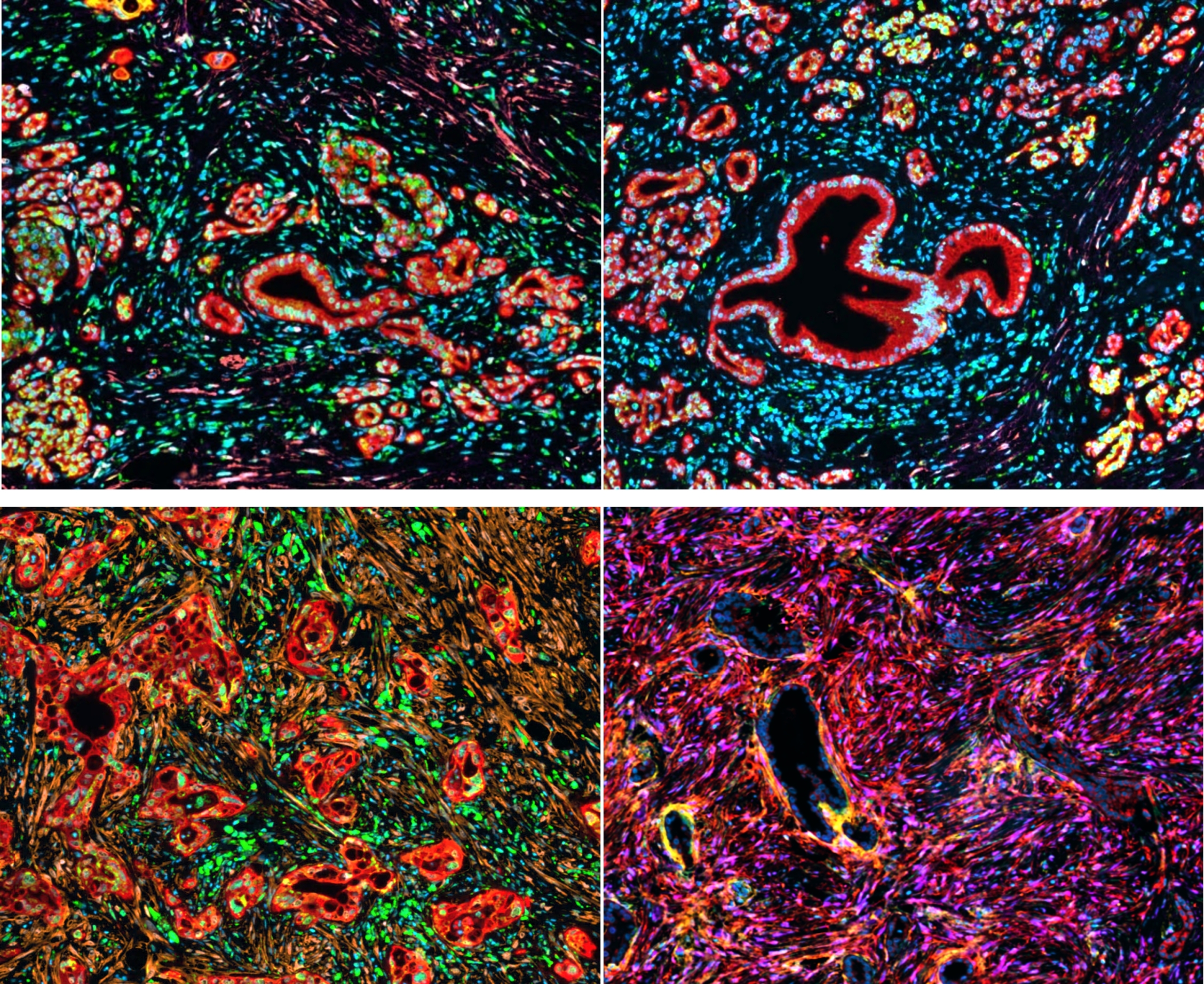 Millionenf&ouml;rderung f&uuml;r Bauchspeicheldr&uuml;senkrebs-Forschung - Titelbild